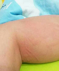 "万能的19楼啊!!!求神医!!!慢性荨麻"