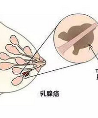 "乳房生了个小肿块 她去店里按摩揉了三个月 结果乳腺癌扩散转移"