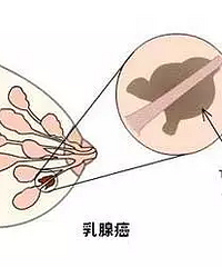 "乳房生了个小肿块 她去店里按摩揉了三个月 结果乳腺癌扩散转移"
