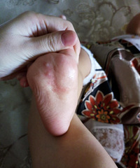 这是什么鬼?宝宝脚底泡疹