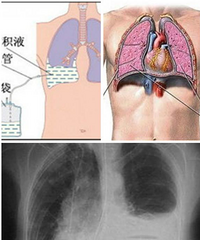 "胸腔积液的原因,不容小觑!"