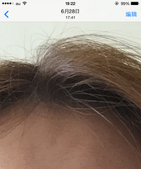 "关于胶原蛋白我自己的心得,附加自己一个月前后的截图照片"