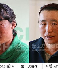 时光公益在行动:半脸烧伤毁容女眉笑颜开恢复良好