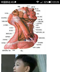 "幼儿斜颈怎么办?(非手术方法)按摩,热敷,锻炼…"