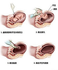 剖宫产不可放松大意 产前事项要牢记