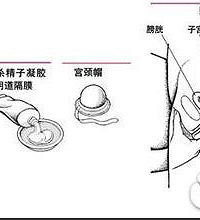 "放置节育环有没有副作用?"