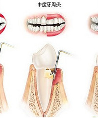 很多中年人发现自己的牙齿开始疼,牙周附着丧失,形成牙周袋,牙齿有不