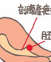 如何正确处理瘢痕妊娠?都有这些症状你知道吗?