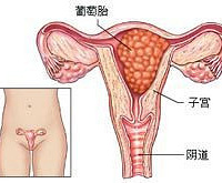 葡萄胎治疗 多久后可以尝试再孕?