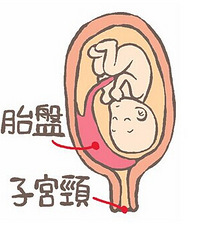 胎盘早剥,为何会胎盘早剥