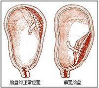 胎盘成熟度,胎盘早熟有危害