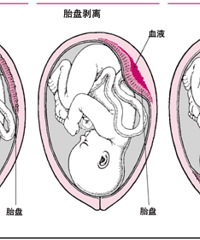 胎盘成熟度,胎盘早熟有危害