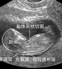 "NT检查价格 影响因素有两种!"