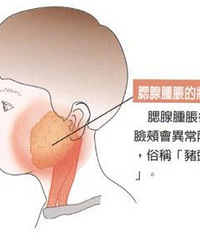 小儿腮腺炎的预防 教你如何护理?