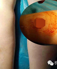 为了快速瘦成一道“闪电”杭州姑娘把自己的腿打烂了