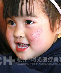 【时光公益】心痛!!4岁小女孩生日当天脸部撞上水果刀!