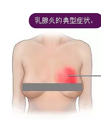 "无需通乳师,小舒教你对付乳腺炎"