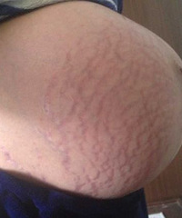 "最近怎么大家都爱发妊娠纹,是要比谁好还是比谁惨啊?那我也来"