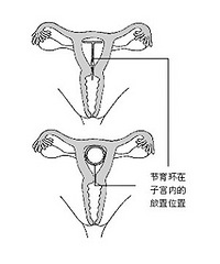 取环手术,来看看吧