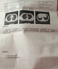 支气管炎咳喘