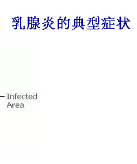 "无需通乳师也能应对乳腺炎"