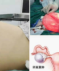 "19岁在校女生腹腔现巨大肿物,肚子隆起似怀孕."