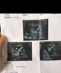 "我的剖腹产经历"