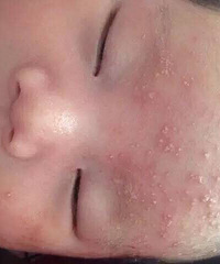 "解决宝宝出痱子"