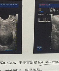 "子宫肌瘤怎么办?给点宝贵意见"