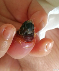 19���СӤ����ָȱѪ���� ԭ����...