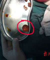 1����ͯ��ʳ��ˮ������  ȡ��ʱ����ƹ�����