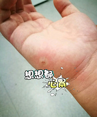 一个小伤口拖了两三年,结果。。。