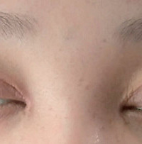 ȥĳ����ҽԺ���˸�˫��Ƥ  ���������۾����ղ�������