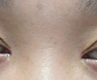 ���˹���ȥ��������ҽԺ��˫��Ƥ ����Ӵ���Ƥ�ϲ����ˣ�