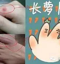 "明明接种了疫苗,可孩子仍得了水痘…还有这些冬季病不容忽视!|