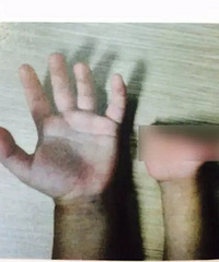 "孕前产检6次均显示正常,婴儿出生后右手一根手指都没有!!"