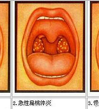 "小儿睡觉打呼噜,告诉你是扁桃体发炎了"