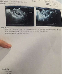 "先兆流产,很担心,会好吗?"
