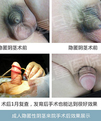 "小儿阴茎隐匿手术治疗医院哪家好"