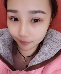 卤煮从小就是不明显的双眼皮 终于存钱解救了寄己