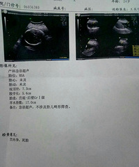 "难受,孕晚期没胎心了"