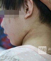 5岁女童遭继母哥哥虐待 9根肋骨骨折