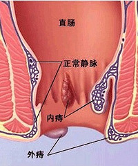 "产后痔疮怎么办 产后痔疮怎样预防"