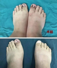 "用力过猛!萧山一姑娘剪指甲摊上大麻烦……看完手好痛"