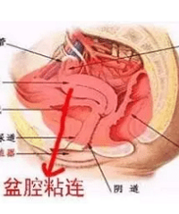 "排卵正常却总是怀不上?小心盆腔粘连在作怪"