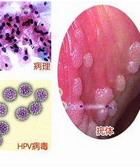 宫颈癌疫苗适合男性接种吗?/香港现代医学专科