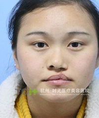 "唇裂女婴被弃雪地三天三夜奇迹生还 19年后做唇裂修复欲报恩"