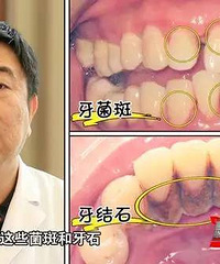 "你的牙龈会出血吗?间歇性出血和长期出血有啥不同?看完就懂"
