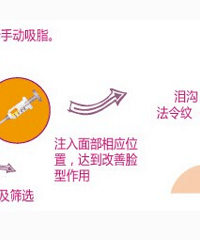 "自体脂肪填充的利弊,3类人不适合"