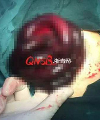 "杭州2岁宝宝腹痛一天,医生剖开肚子:60"